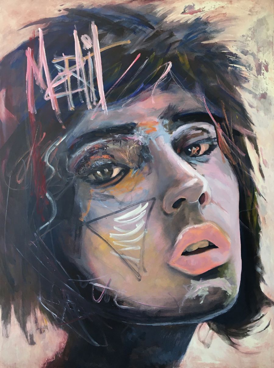 Concussion